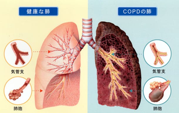 COPDイラスト