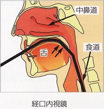 経口内視鏡